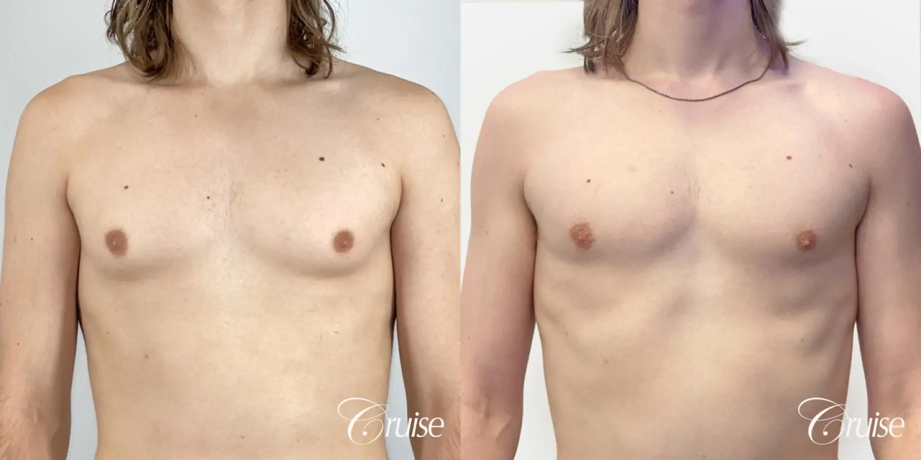 Gynecomastia Before & After Photos Charlotte North Carolina