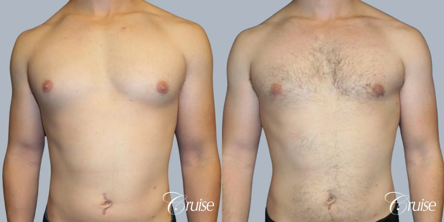 Adult gynecomastia before and after photos - Before and After 1