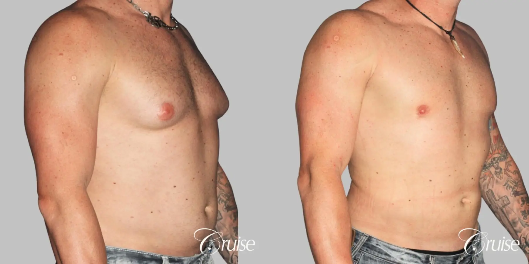 Athletic adult gynecomastia with glandular tissue removal - Before and After 2