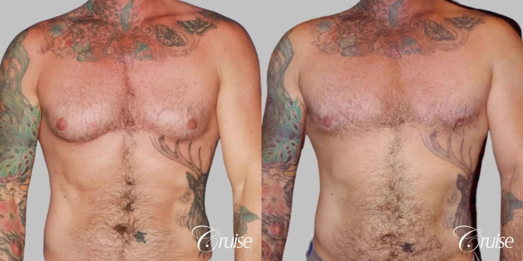 adult gynecomastia - Before and After