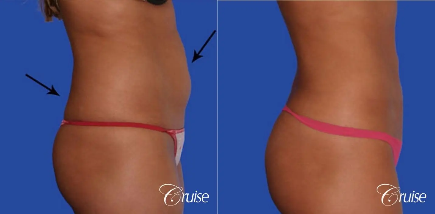 Mini Tummy Tuck Before and After Photo Gallery, Los Angeles, CA