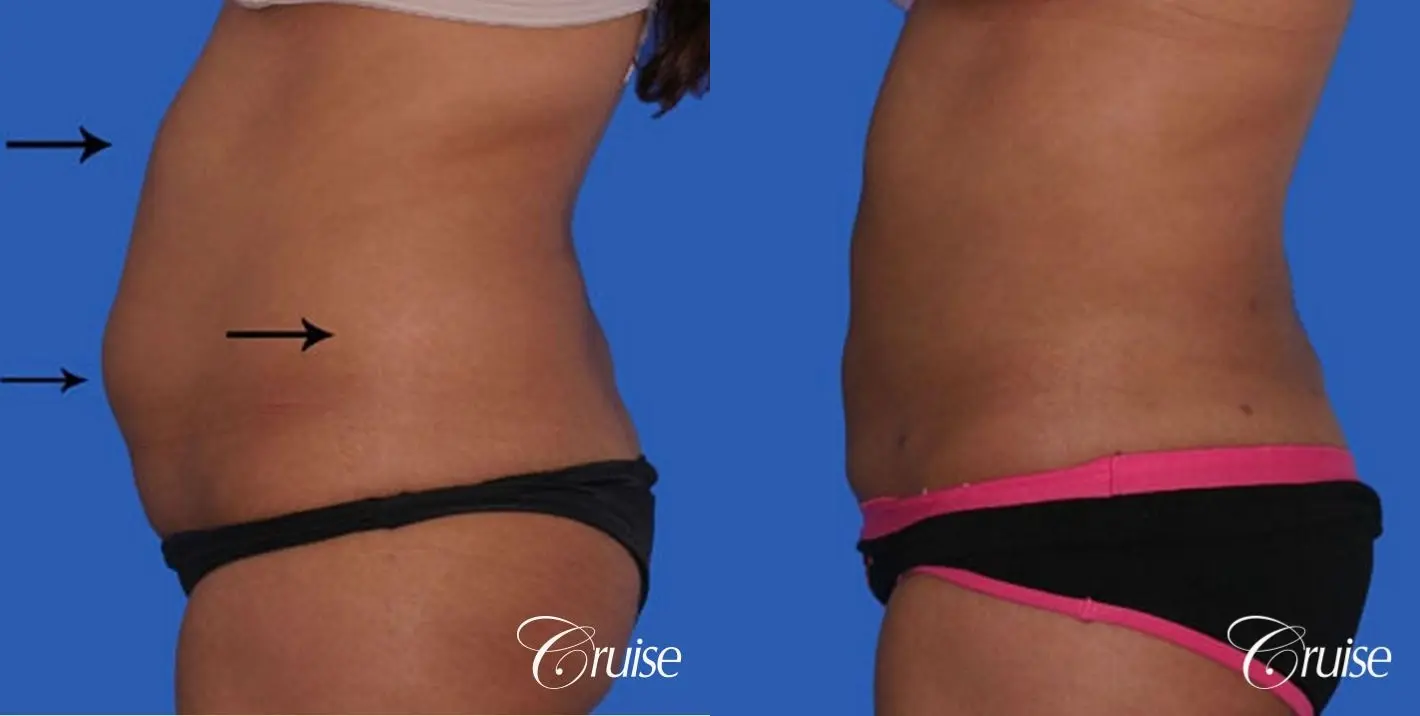 Flanks Liposuction  Before and After Photos - Palm Clinic