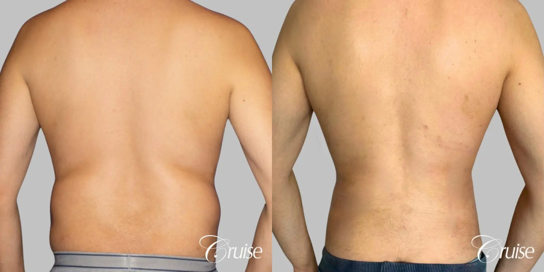 Liposuction: Patient 52 - Before and After 1