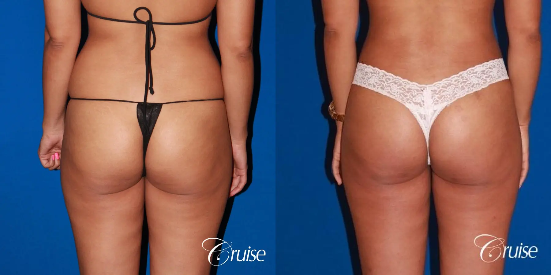 How Can I Remove Fat from My Flanks?, Liposuction Newport Beach