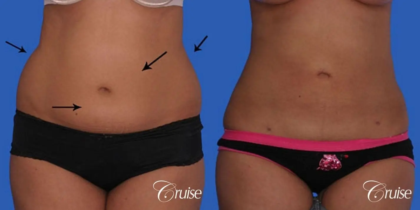 Liposuction Before & After Gallery: Patient 17