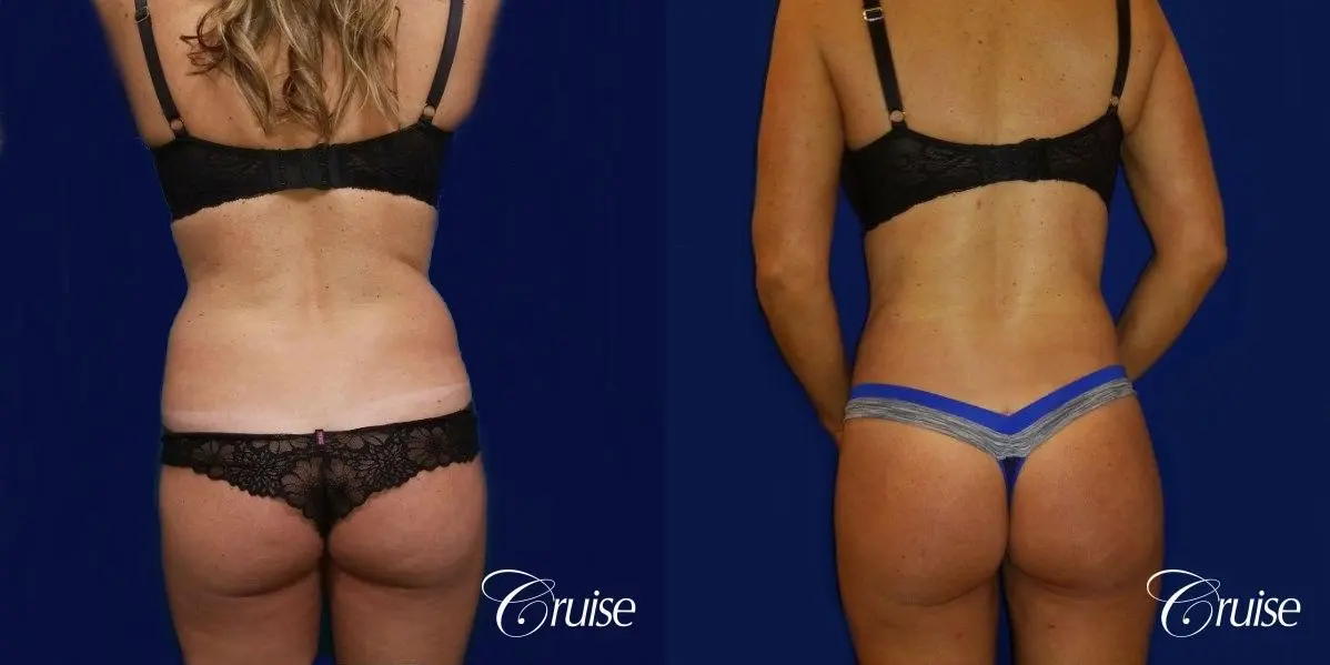 Brazilian Butt Lift Before and After - Dr. Kalantarian Plastic Surgery