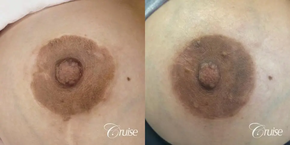 Medical Tattooing: Patient 13 - Before and After 1