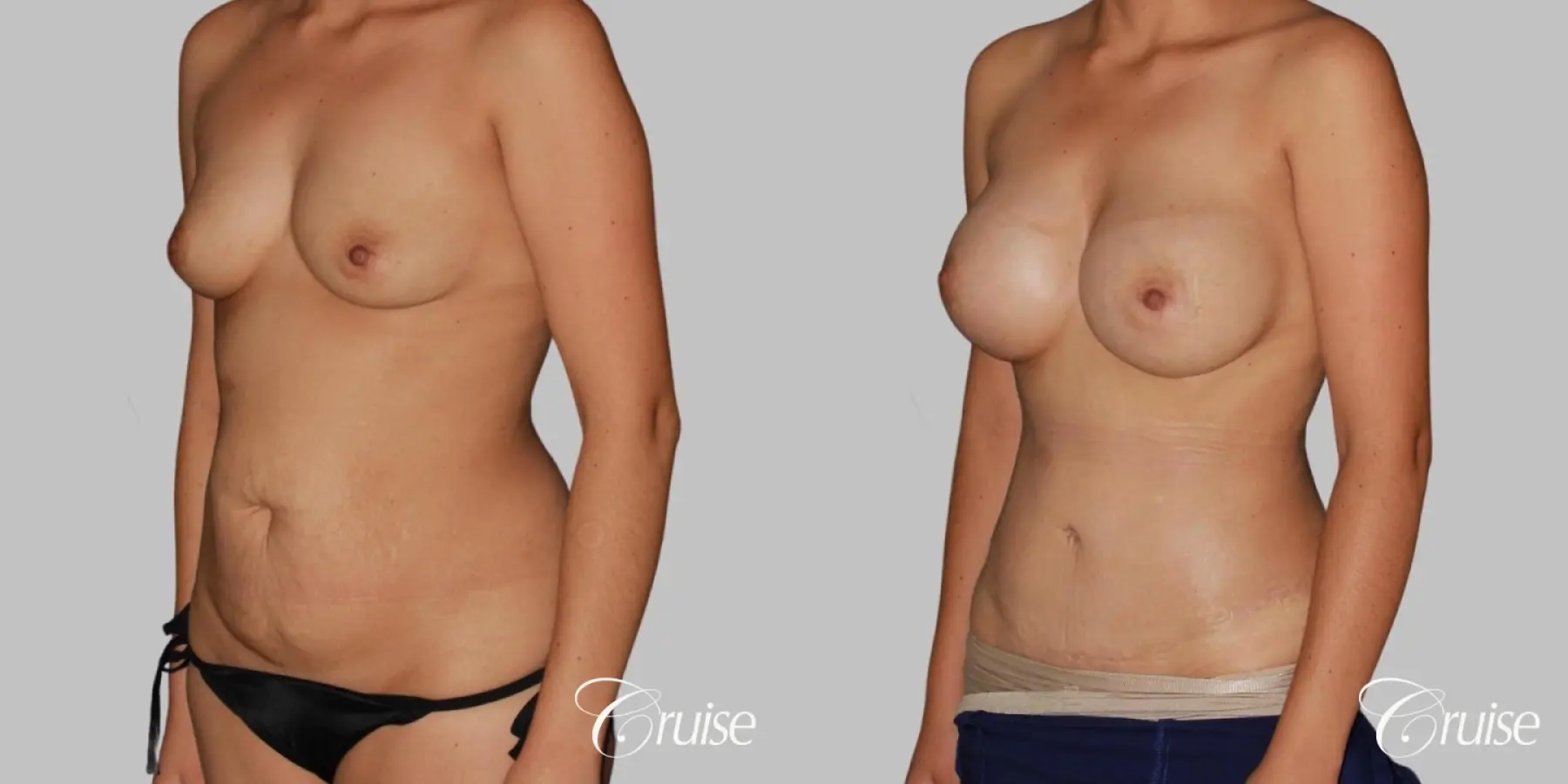 Mommy Makeover Surgery with Saline Augmentation - Before and After 2