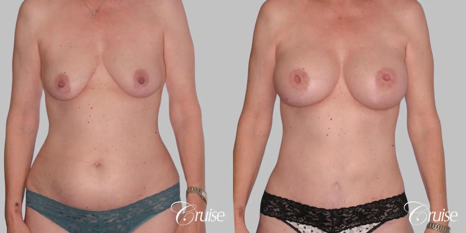 Mommy Makeover - Mini Tummy Tuck w/ Liposuction - Before and After  