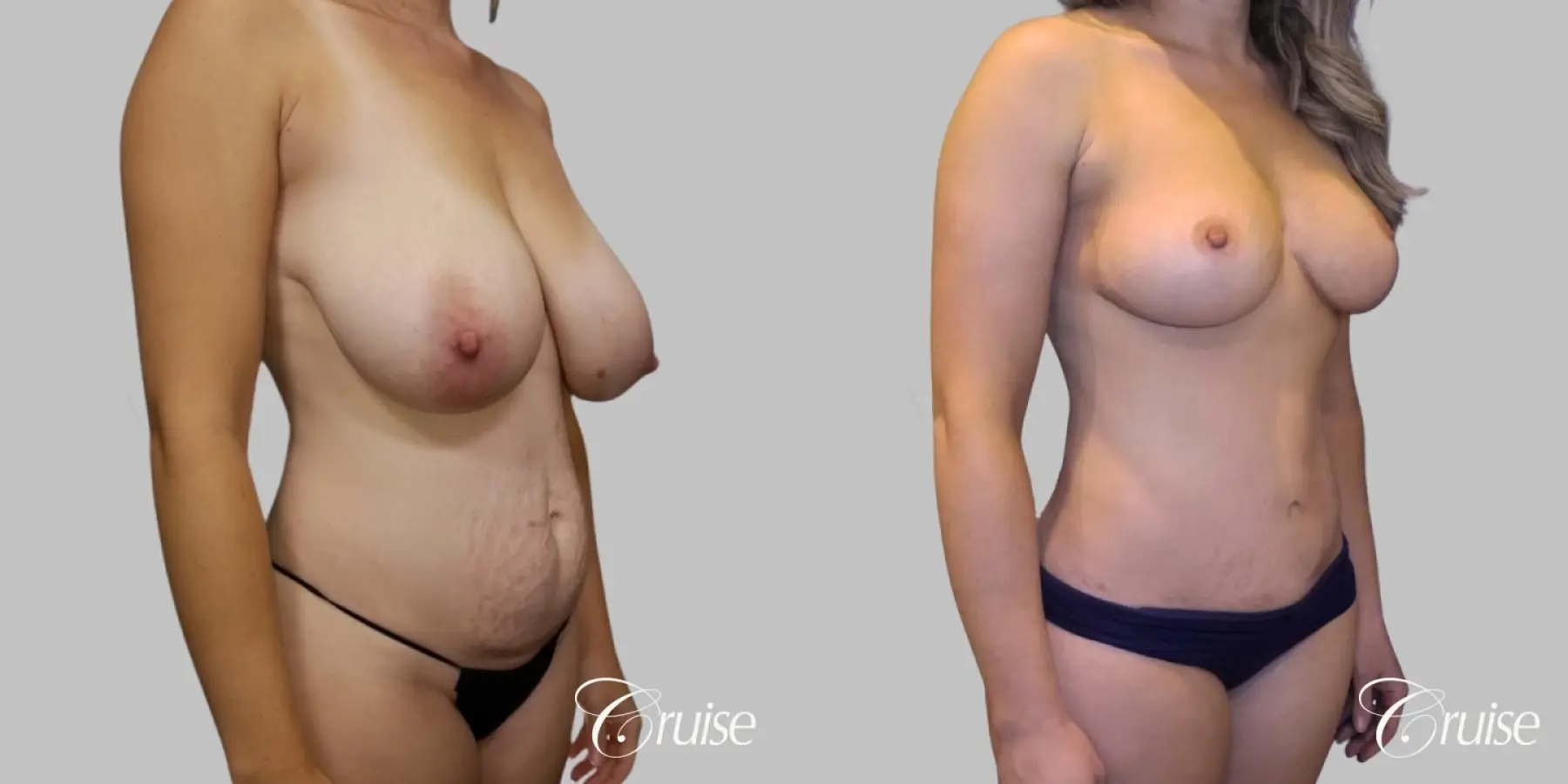 Mommy Makeover - No Implants - Before and After 2