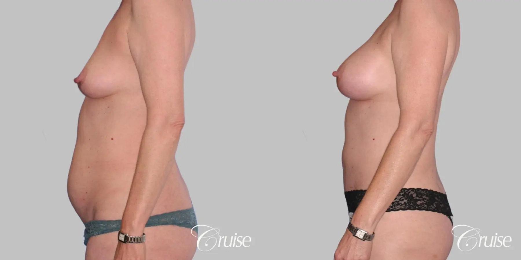 Mommy Makeover - Mini Tummy Tuck w/ Liposuction - Before and After 2