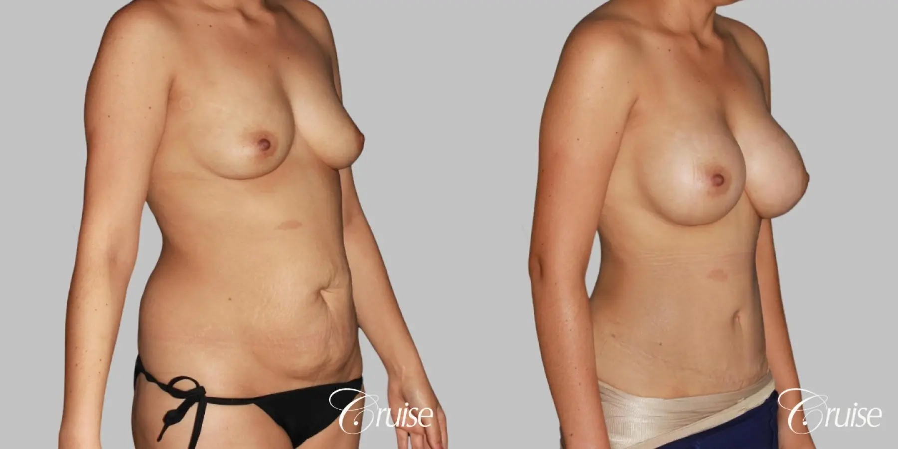 Mommy Makeover Surgery with Saline Augmentation - Before and After 3