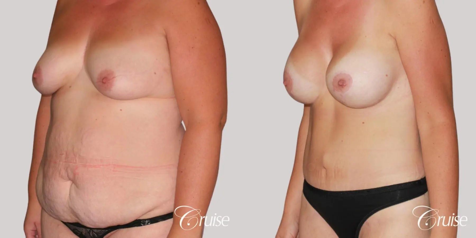 best mommy make over scars on massive weight loss silicone - Before and After 3