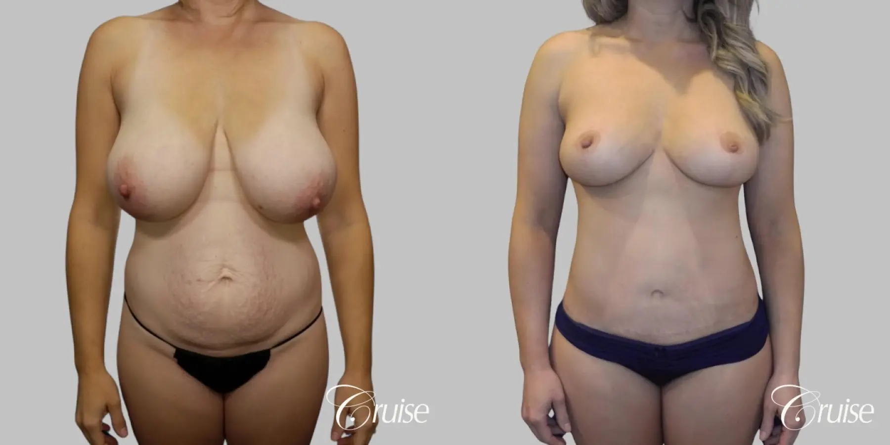 Mommy Makeover - No Implants - Before and After  