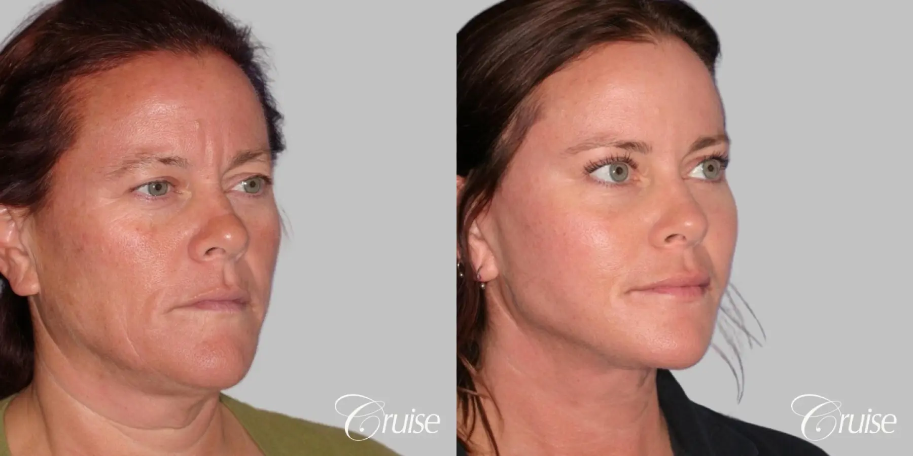 Face Lift, Neck Lift, Upper Blepharoplasty, Temple Lift - Before and After 3