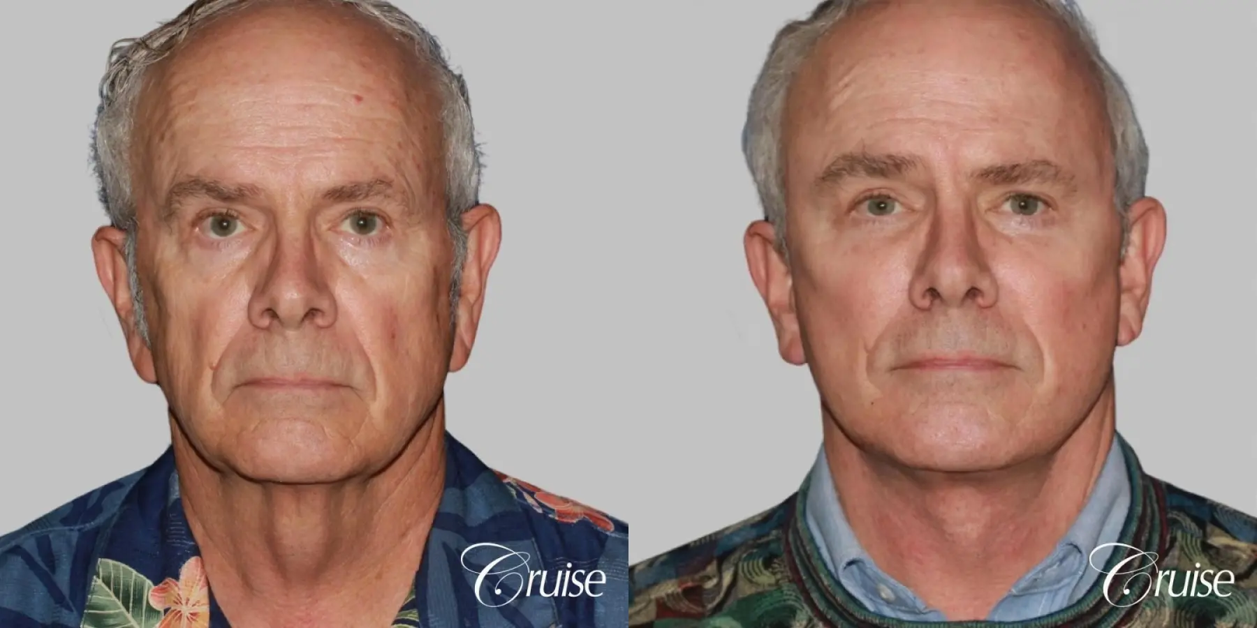 Facelift in Newport Beach, CA - Before and After 1