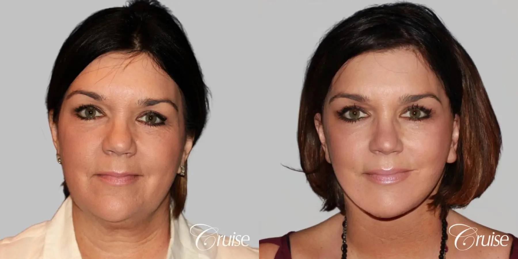 midface with lower face and neck lift orange county - Before and After 1