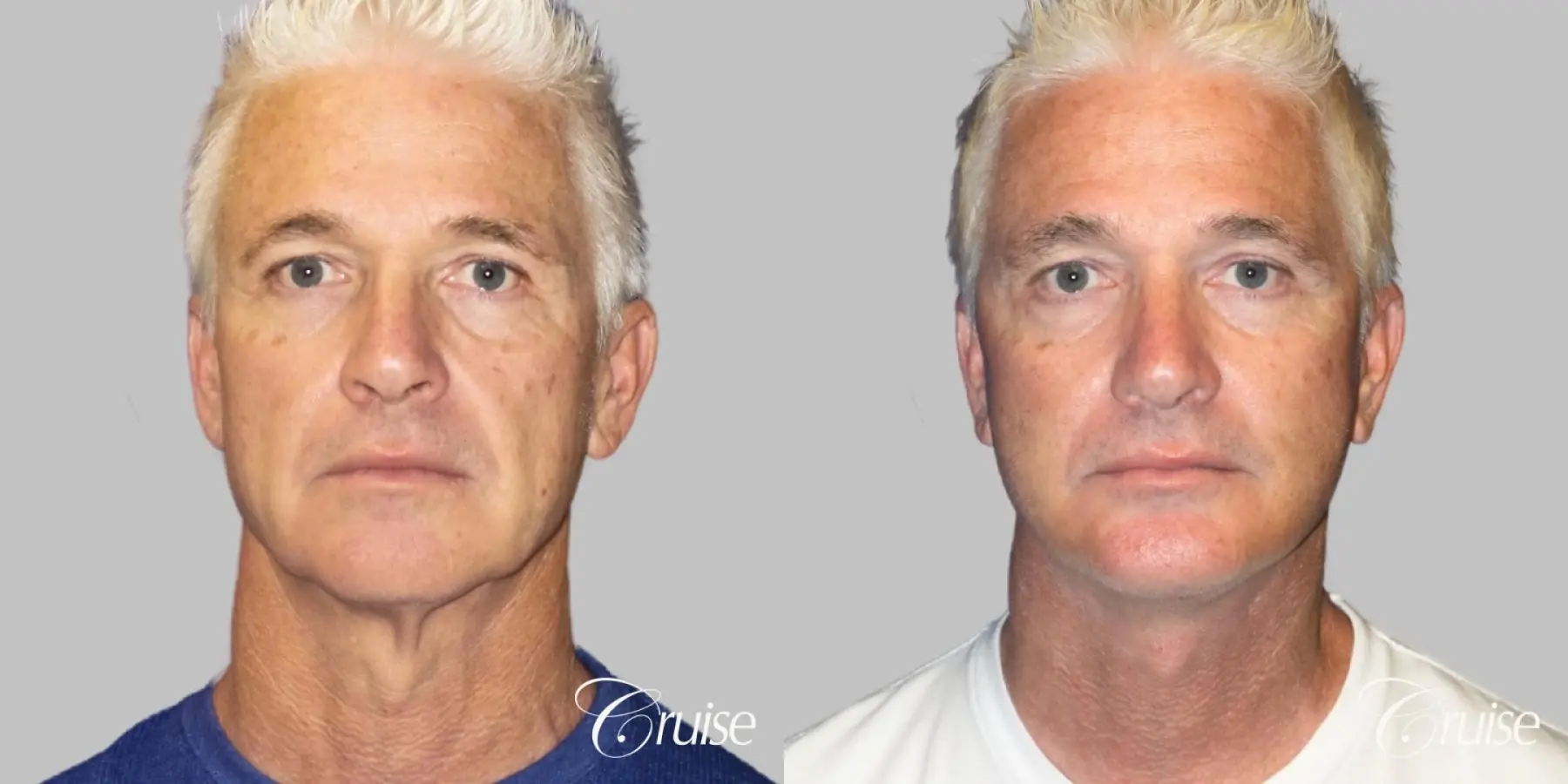 Male neck lift before and after - Before and After