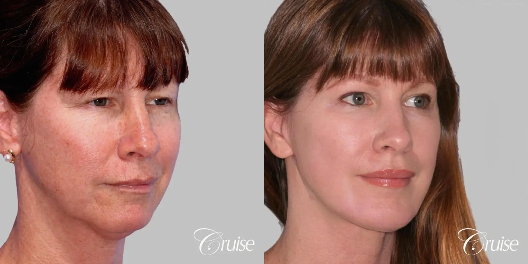 Facelift in Newport Beach, CA - Before and After 2