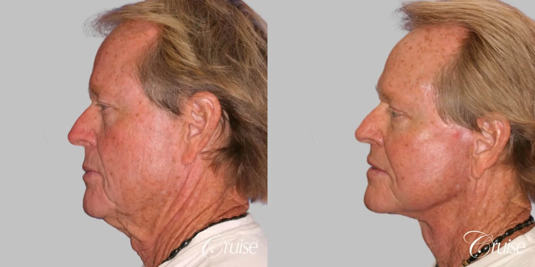 Male Facelift, Necklift, Fat Transfer, Temple Lift - Before and After 3