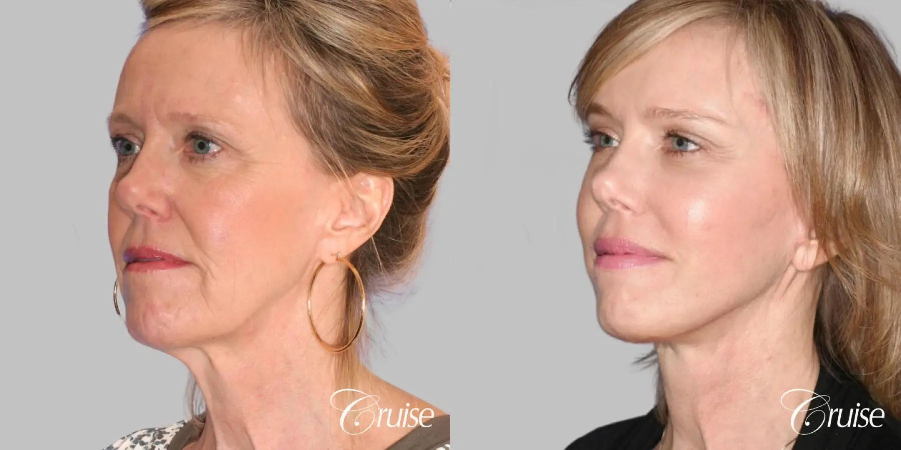 Female Facelift, NeckLift, Neck Midline Plication, Fat Transfer - Before and After 2