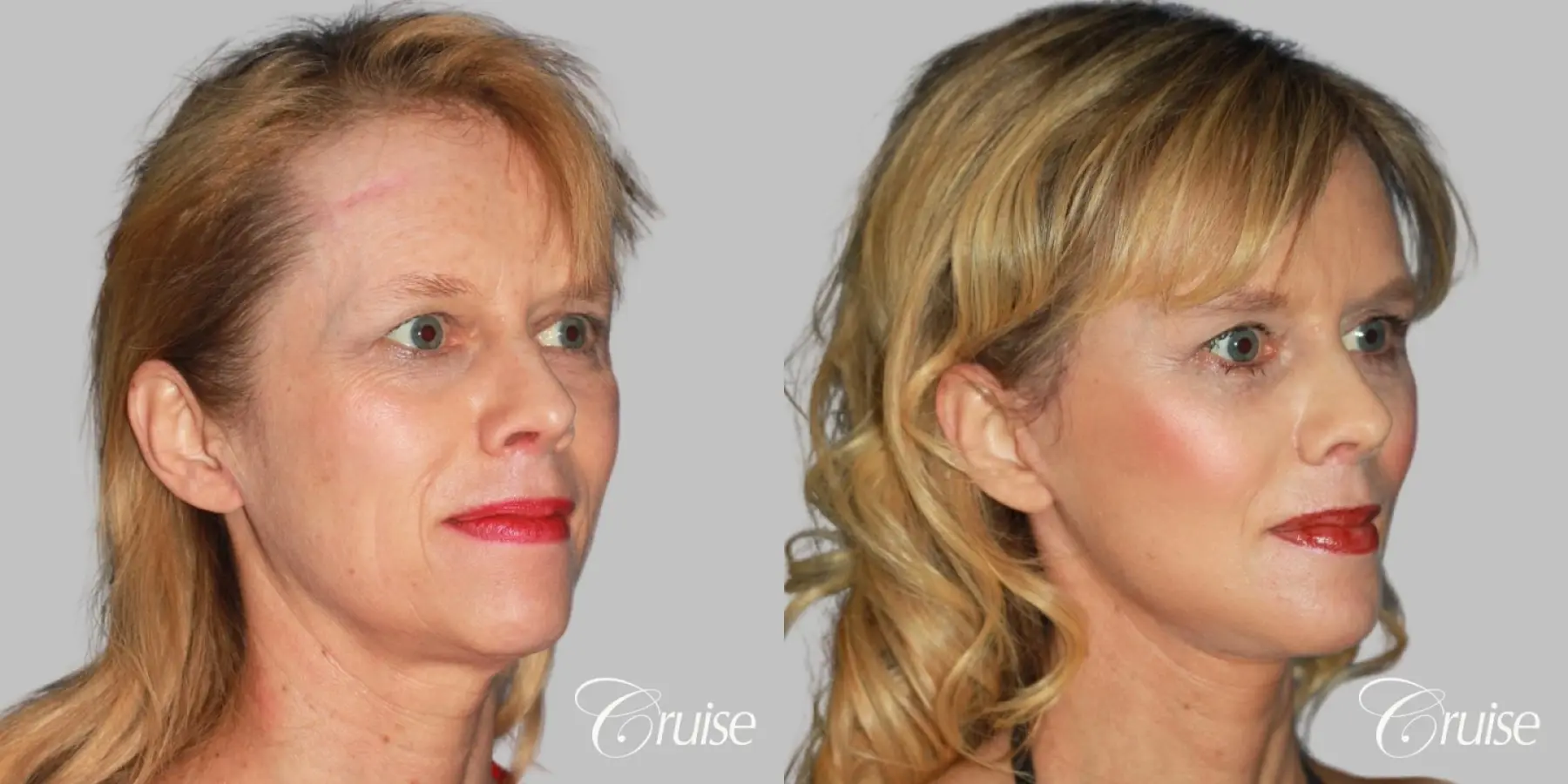 facial rejuvenation newport beach ca - Before and After 3