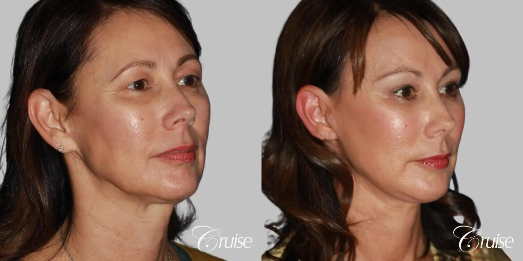 Female Facelift, Neck Midline Plication, Blepharoplasty, and Temple Lift Surgery - Before and After 2