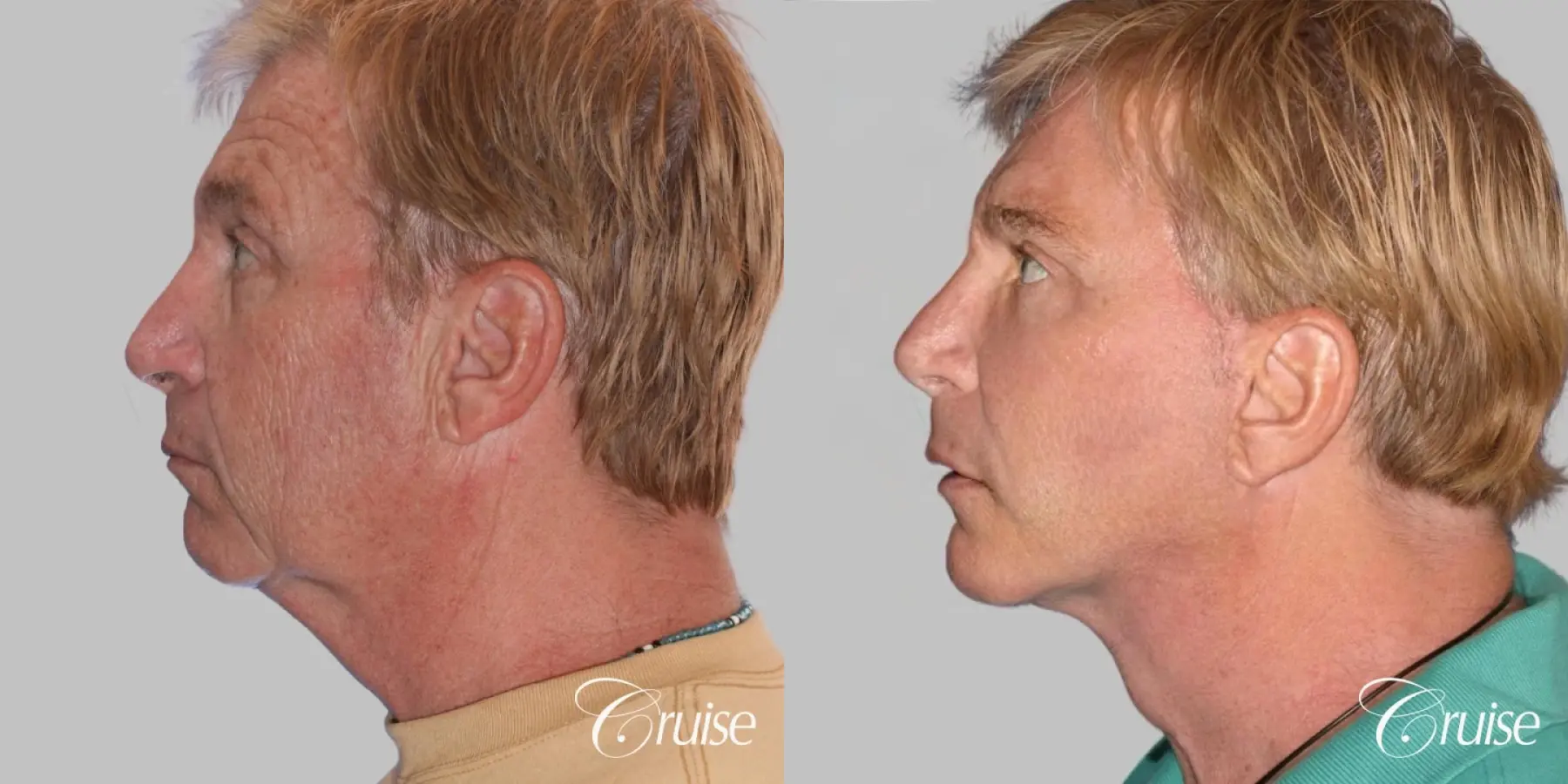 Male Facelift, Browlift, and Fat Transfer - Before and After 3