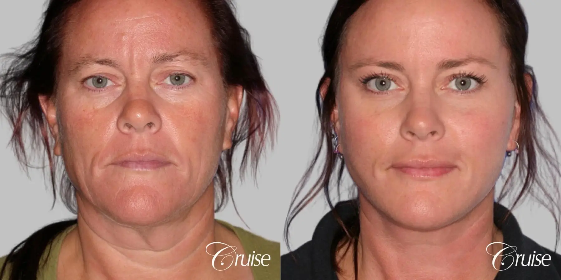 Face Lift, Neck Lift, Upper Blepharoplasty, Temple Lift - Before and After  