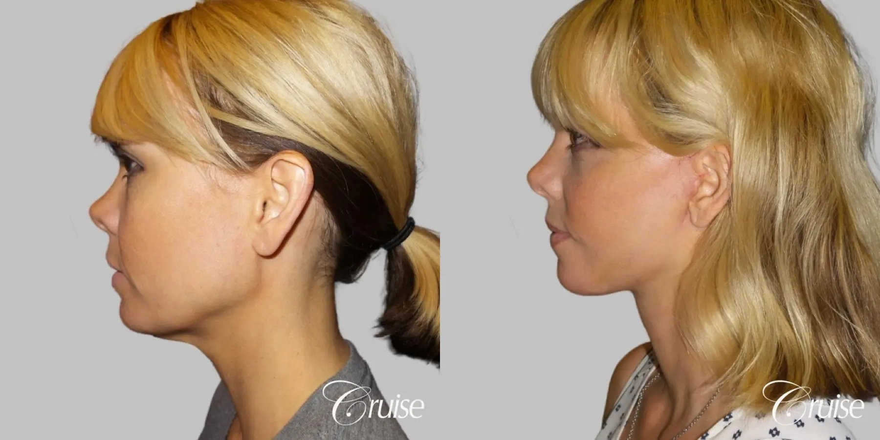 Lower Face Lift with Neck Midline Plication - 45 yr old - Before and After 3