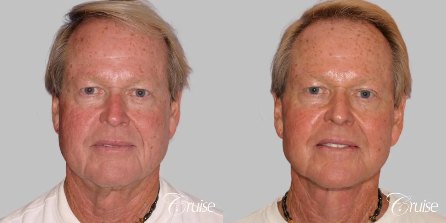 Male Facelift, Necklift, Fat Transfer, Temple Lift - Before and After  