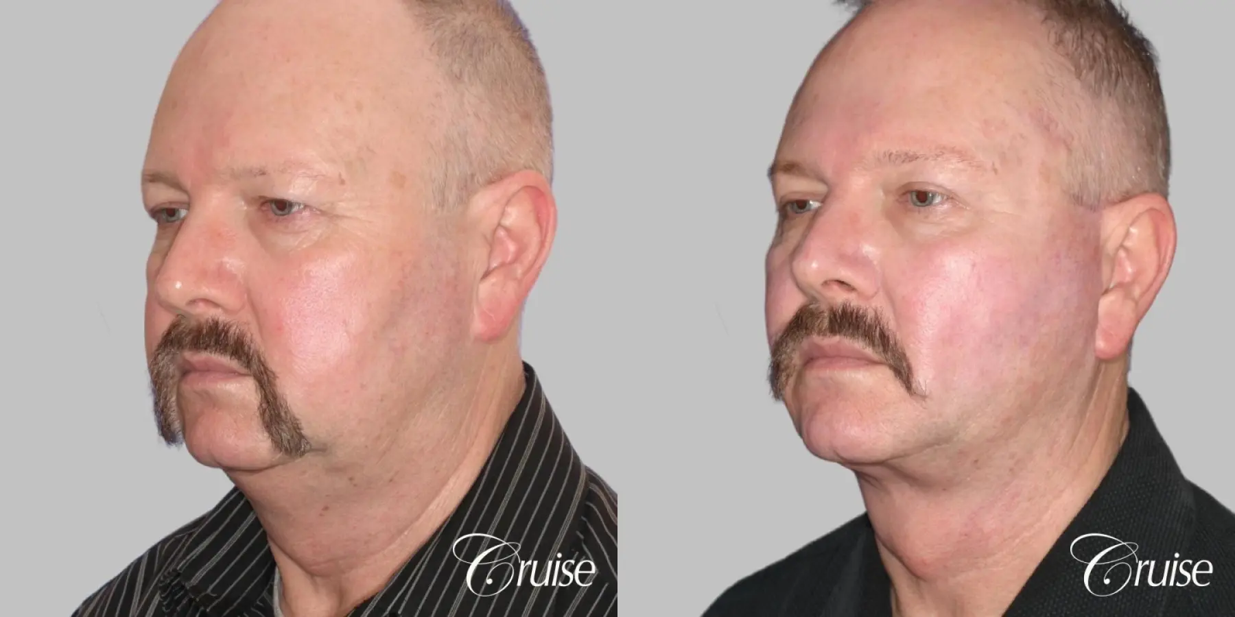 Male Facelift, Neck Lift, Blepharoplasty, Temple Lift - Before and After 2