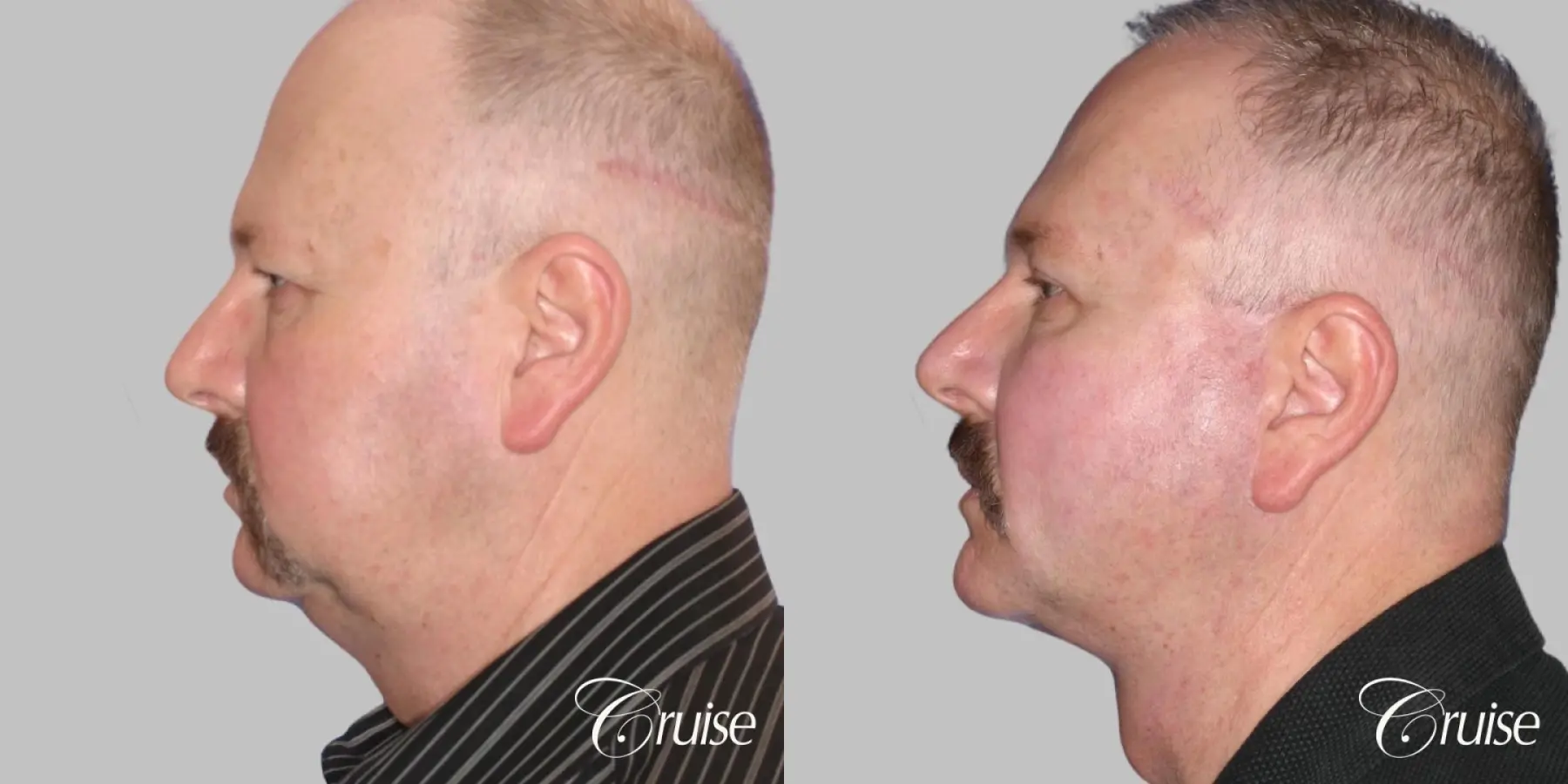 Male Facelift, Neck Lift, Blepharoplasty, Temple Lift - Before and After 3