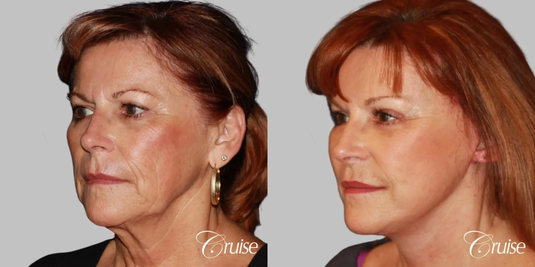 facial rejuvenation orange county ca - Before and After 2