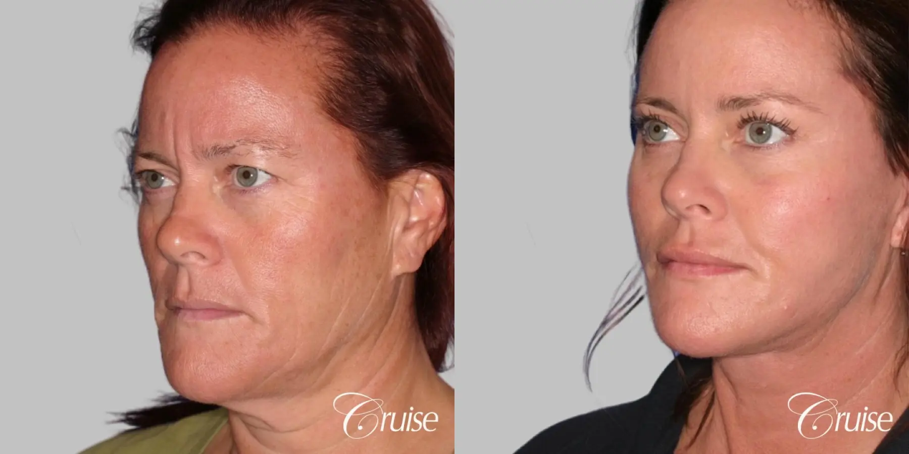 Face Lift, Neck Lift, Upper Blepharoplasty, Temple Lift - Before and After 2