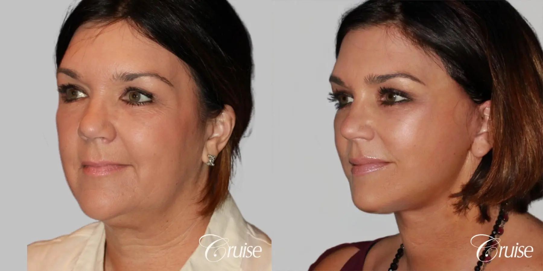 midface with lower face and neck lift orange county - Before and After 2