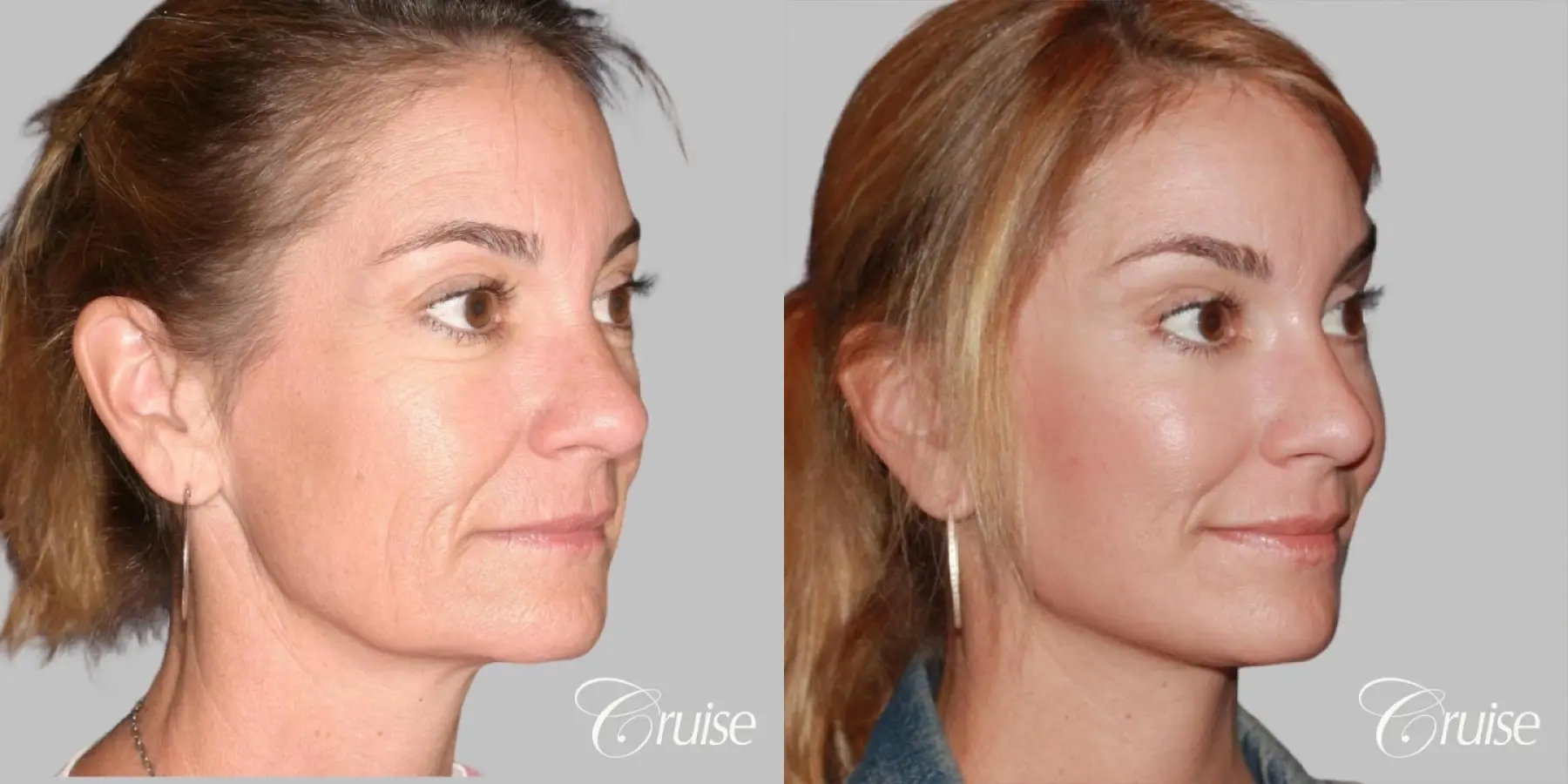 Female - Facelift, Neck Tightening, Fat Transfer - Before and After 2