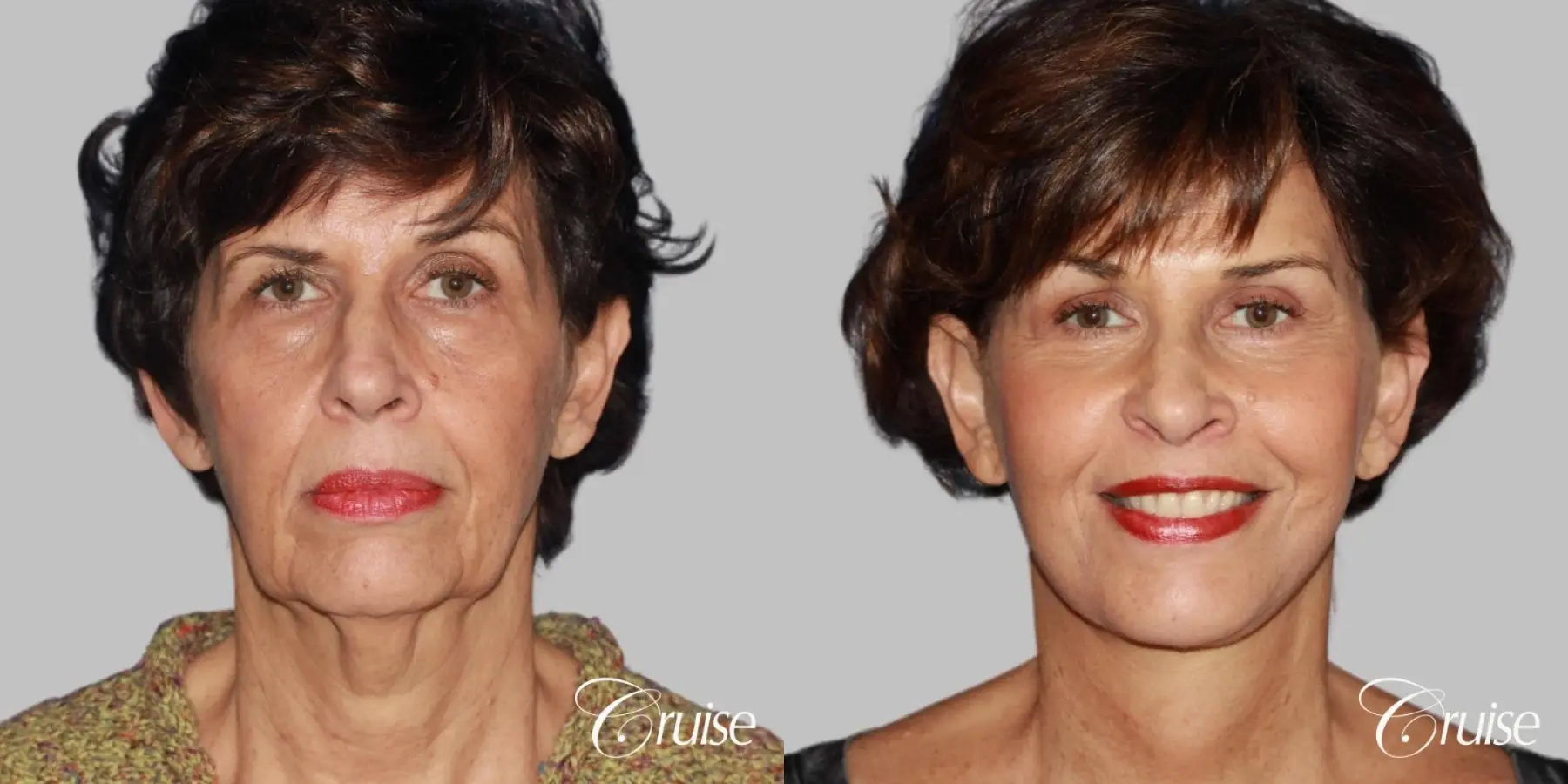 facelift surgery dr. cruise - Before and After