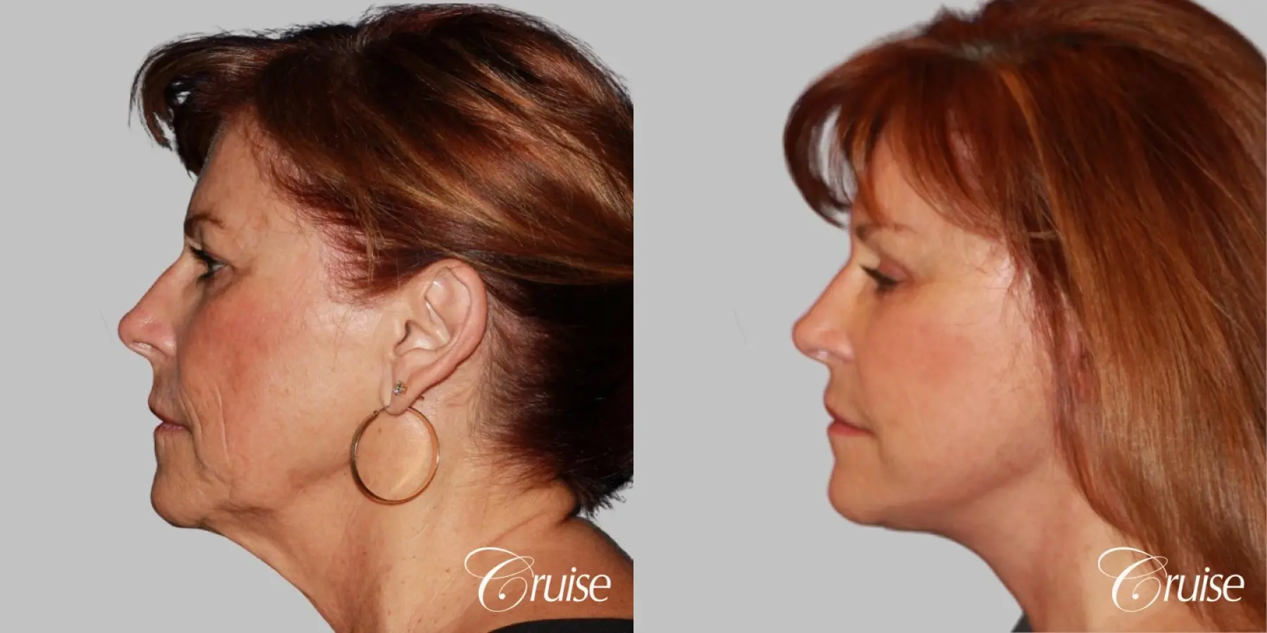 facial rejuvenation orange county ca - Before and After 3