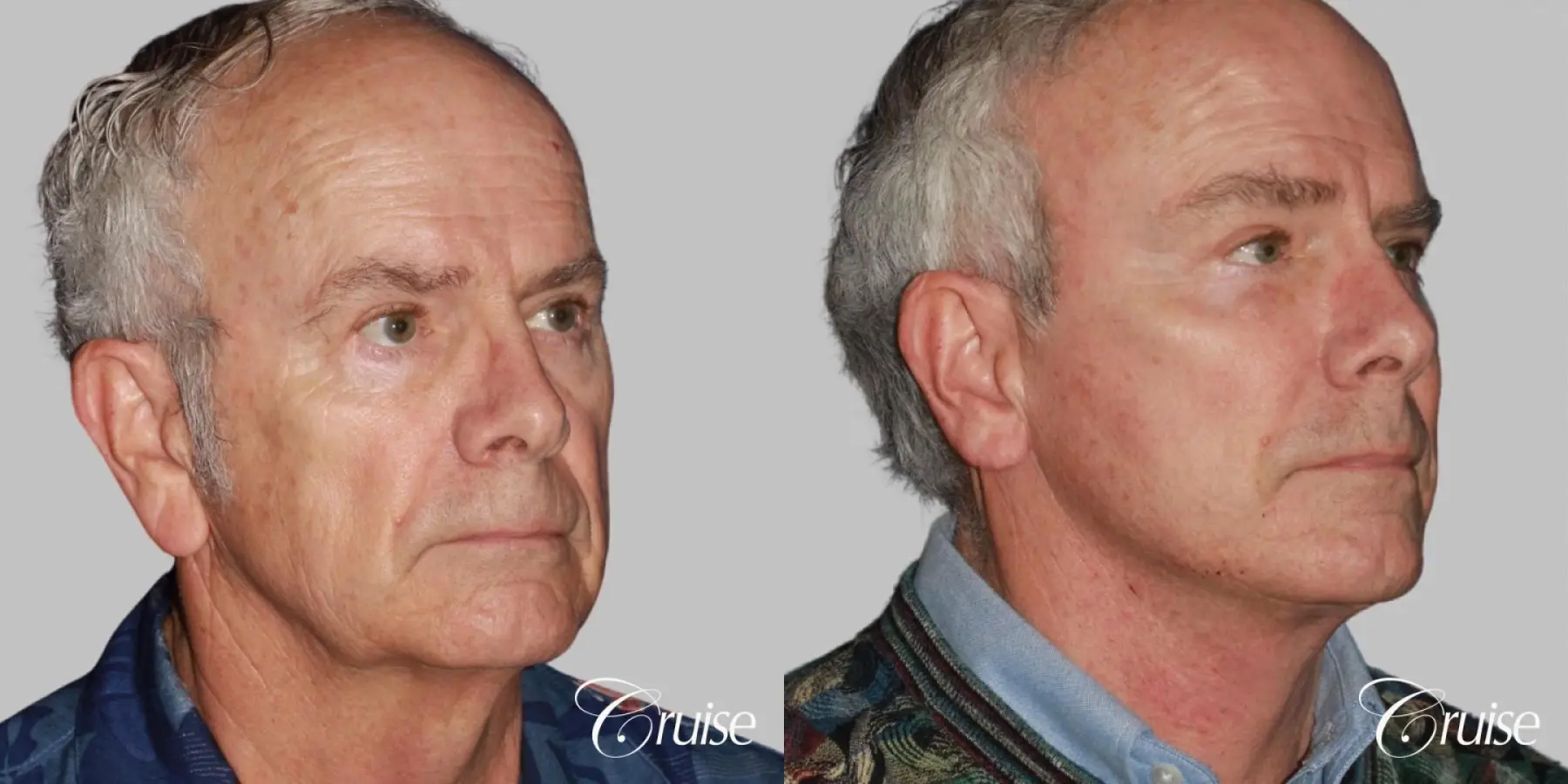 Facelift in Newport Beach, CA - Before and After 2