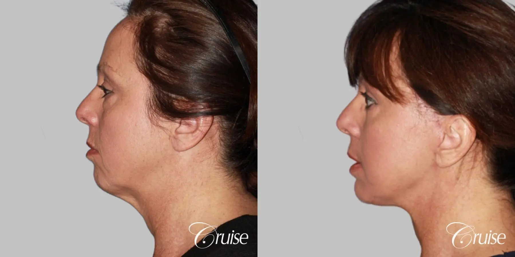 Facelift in Newport Beach, CA - Before and After 2