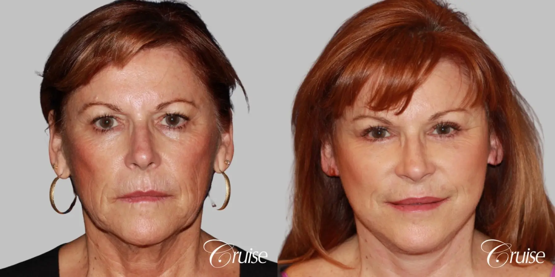 facial rejuvenation orange county ca - Before and After 1