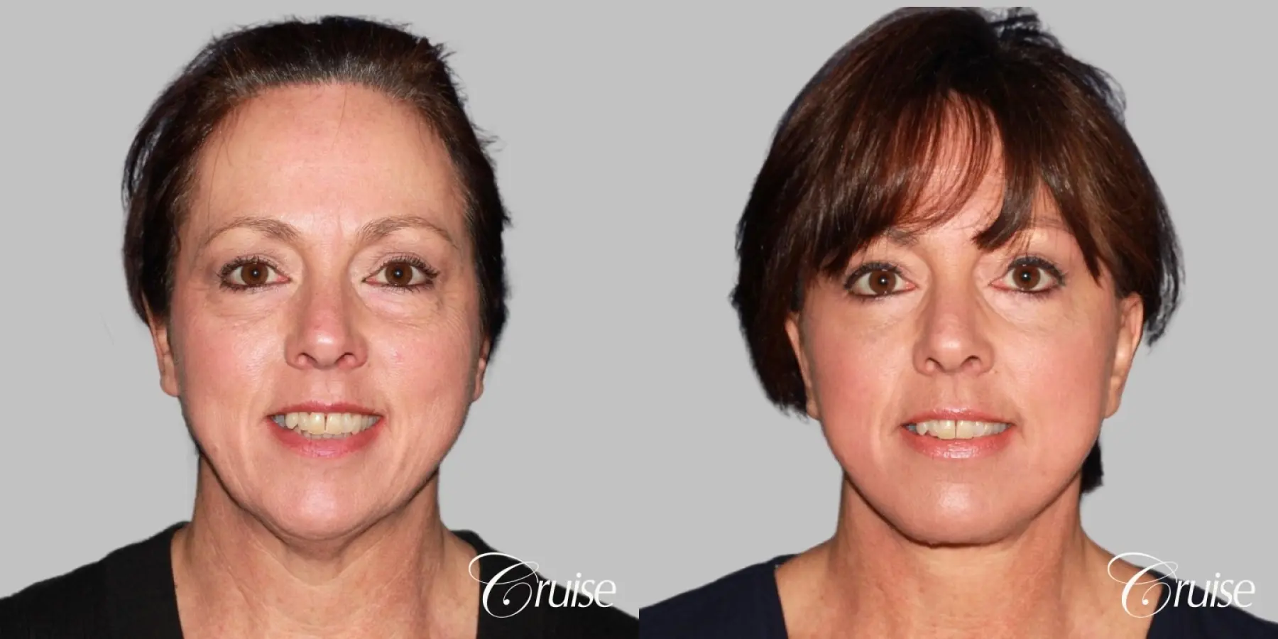 Facelift in Newport Beach, CA - Before and After 1