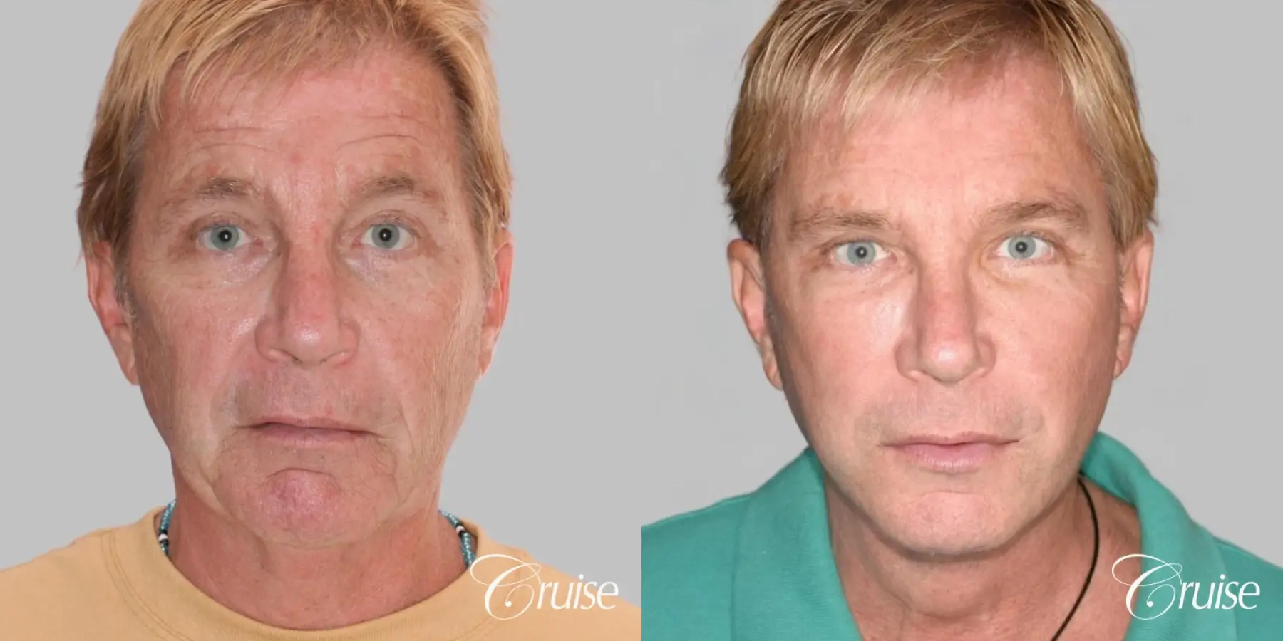 Male Facelift, Browlift, and Fat Transfer - Before and After 1