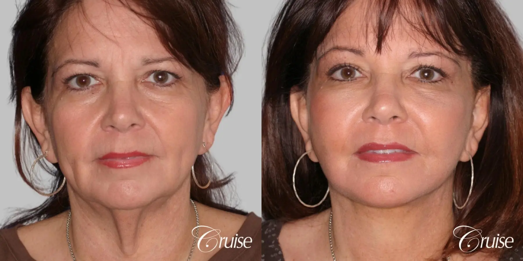 Female - Facelift, Neck Midline Plication, Fat Transfer to Cheeks - Before and After  
