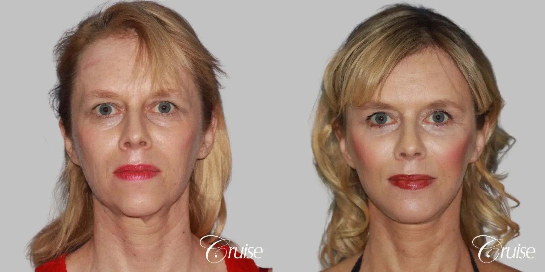 facial rejuvenation newport beach ca - Before and After 1