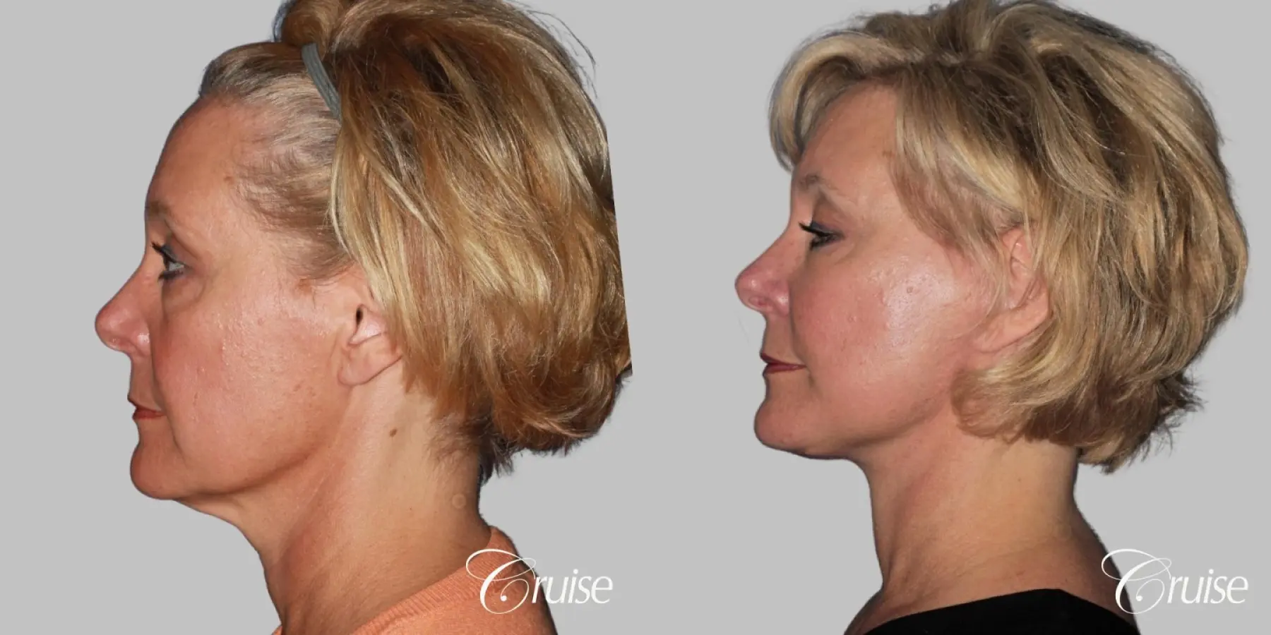 Female Facelift, Temple Lift, Fat Transfer, Neck Lift - Before and After 3