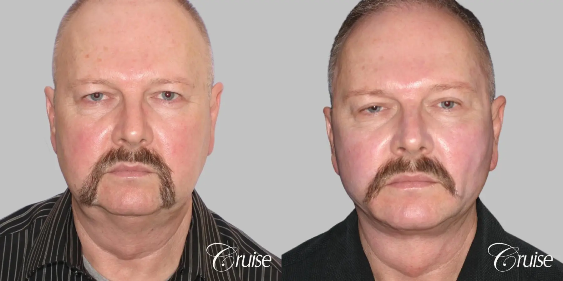 Male Facelift, Neck Lift, Blepharoplasty, Temple Lift - Before and After 1