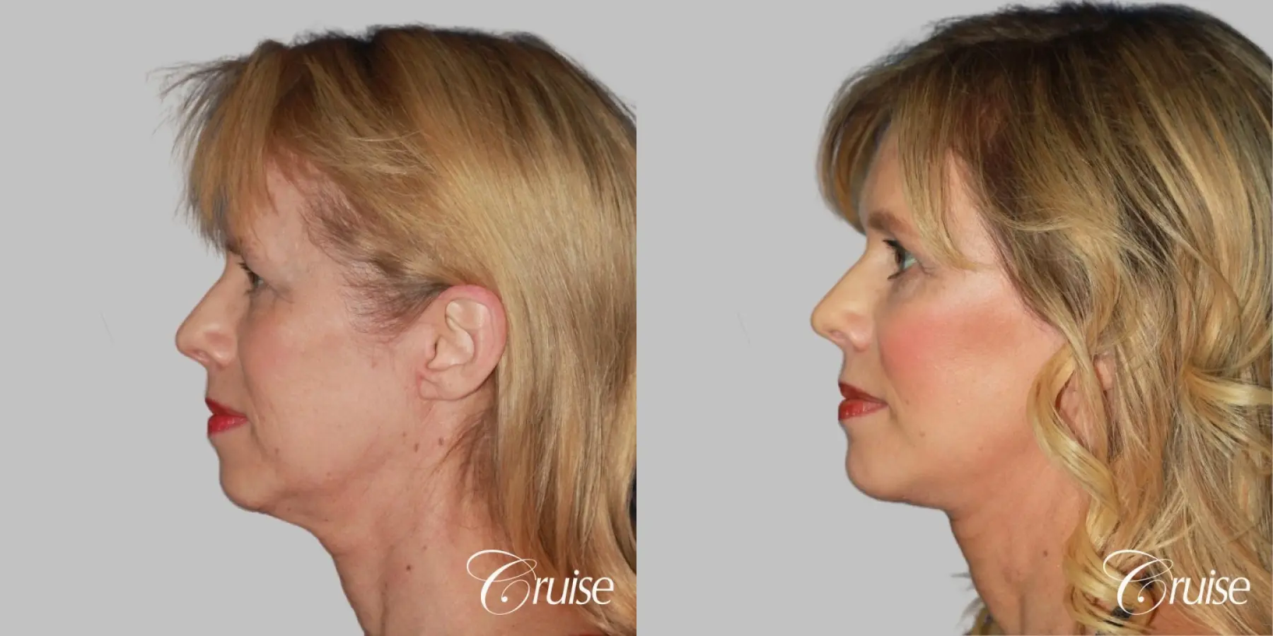 facial rejuvenation newport beach ca - Before and After 2