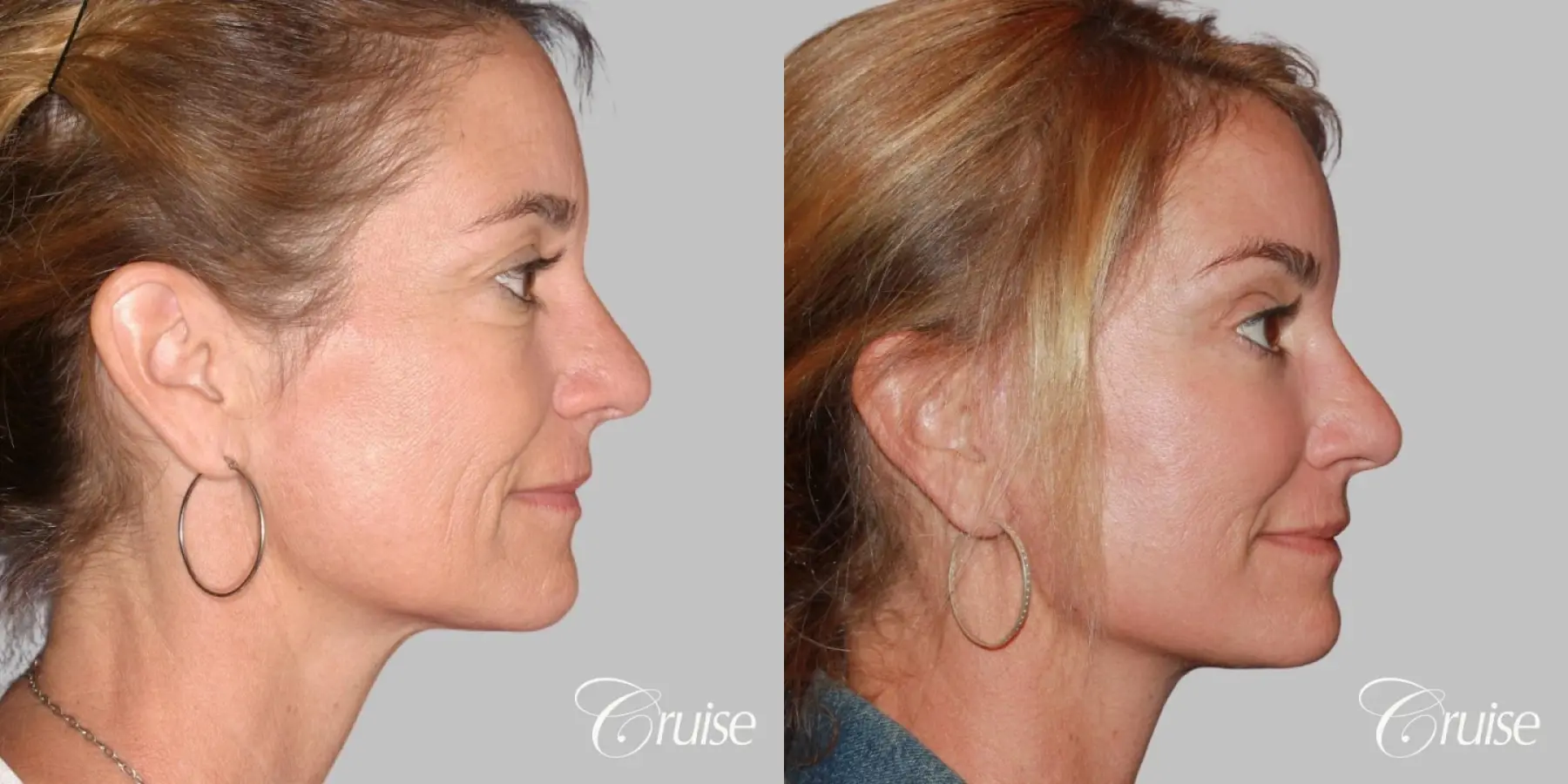 Female - Facelift, Neck Tightening, Fat Transfer - Before and After 3